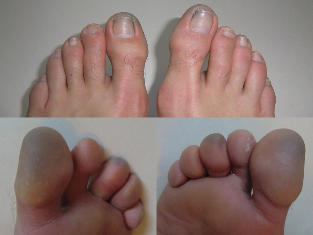 Frostbite and Cold WeatherRelated Injuries Heather Earles